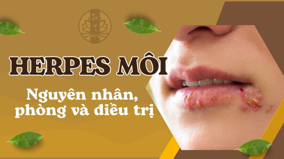 Herpes môi nguyên nhân cách phòng và điều trị