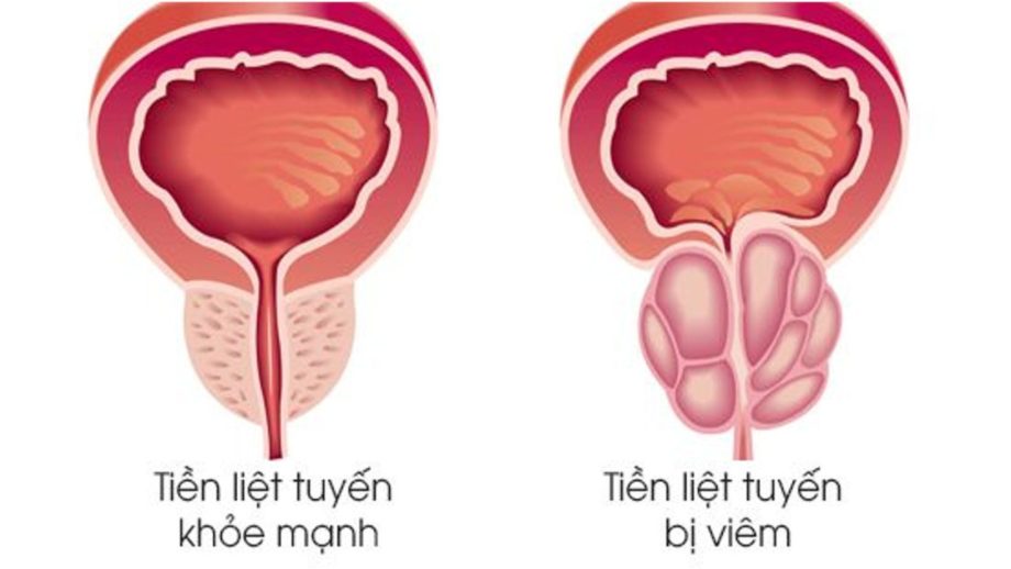 Viêm tinh hoàn dẫn đến biến chứng bị viêm tuyến tiền liệt