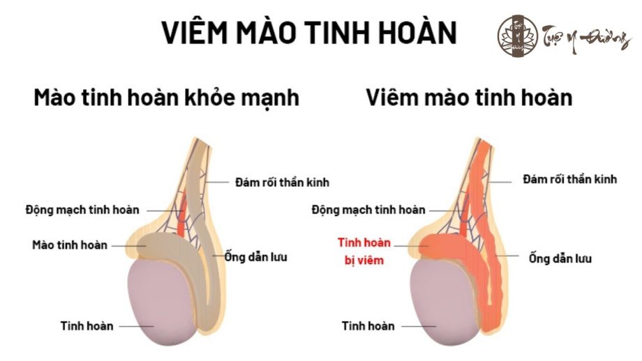 Viêm mào tinh hoàn