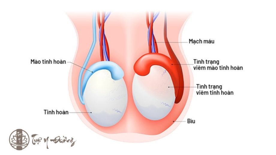 Bệnh nhân bị viêm tinh hoàn quai bị cấp tính sẽ có những biểu hiện như tinh hoàn sưng to (gấp 2 – 3 lần bình thường), đau vùng bìu,