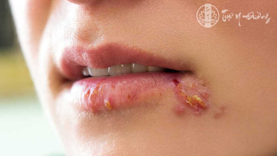 Những triệu chứng thường thấy của herpes môi