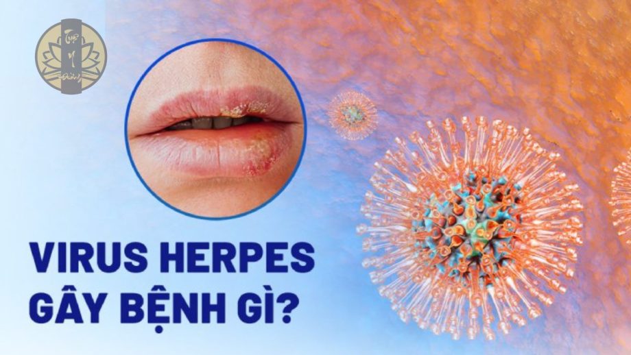 Virus herpes là một trong những nguyên nhân gây nên tình trạng herpes môi