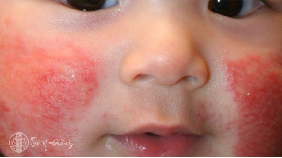 Xà sàng tử Điều trị bệnh chàm da cho trẻ em có biểu hiện viêm loét, chảy mủ
