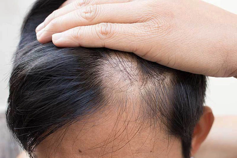 Trường hợp tóc rụng lâu ngày, chân tóc yếu hoặc bạc tóc sớm dùng Diên phát đan rất tốt