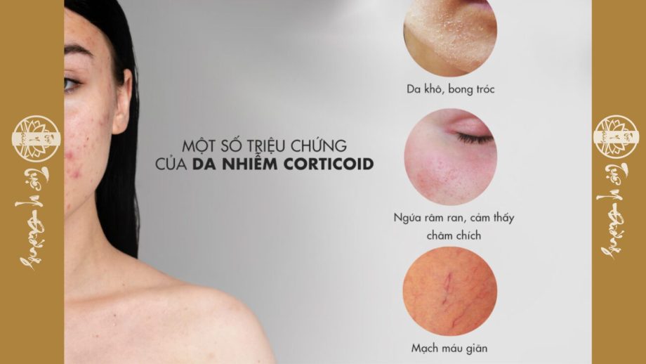 Triệu chứng da nhiễm corticoid