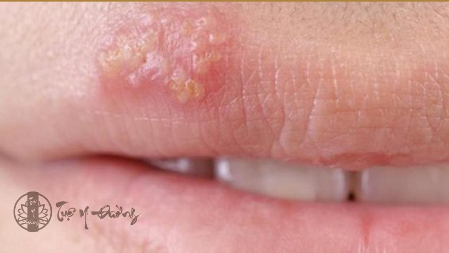 Triệu chứng của herpes môi