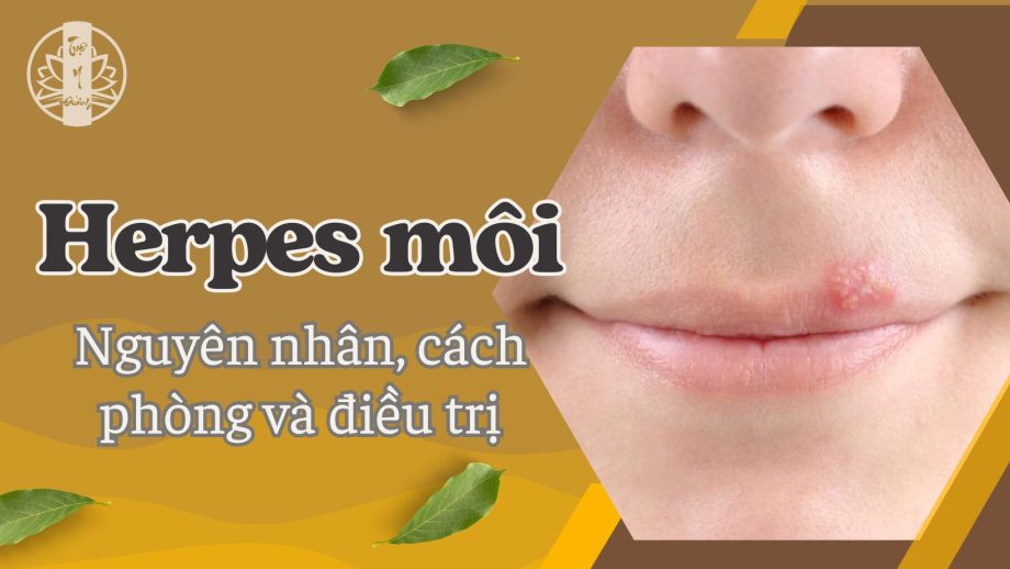 Herpes môi, nguyên nhân cách phòng và điều trị bệnh