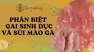 Phân biệt gai sinh dục và sùi mào gà