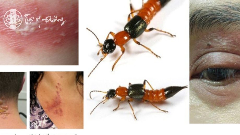 Biểu hiện viêm da tiếp xúc do côn trùng kiến ba khoang đốt
