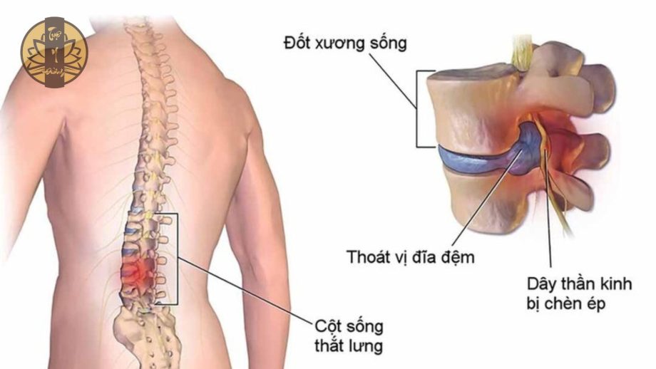 Tình trạng chèn ép dễ thần kinh