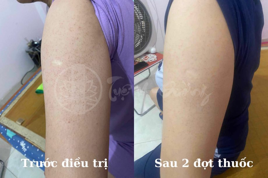 Dày sừng nang lông sau 2 đợt thuốc điều trị tại Tuệ Y Đường 