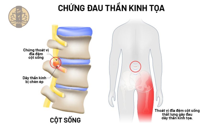 Chứng đau thần kinh tọa theo Y Học Hiện Đại 