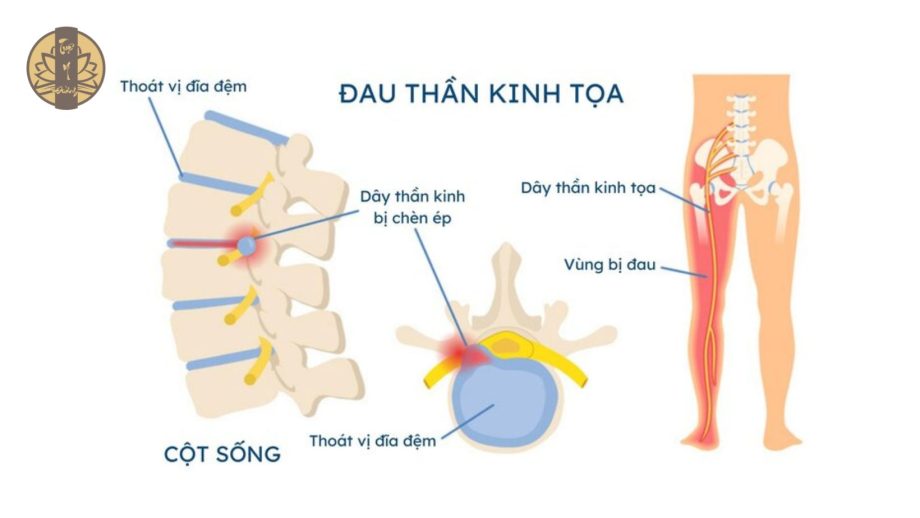 Chứng đau dây thần kinh tọa trong Y Học Cổ Truyền được gọi là chứng Yêu Cước Thống