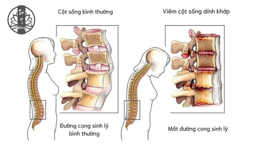 Viêm cột sống dính khớp là 1 trong những nguyên nhân dẫn đến đau dây thần kinh tọa