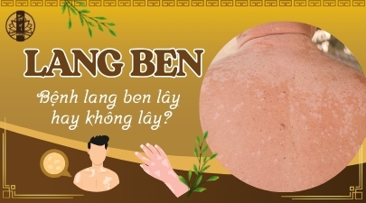 Bệnh lang ben - Bệnh lang ben lây hay không lây?