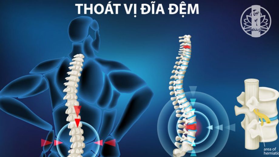 Thoát vị đĩa đệm là một trong những nguyên nhân dẫn đến tình trạng đau lưng