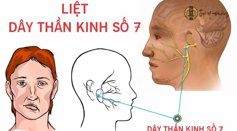 Liệt dây thần kinh số 7