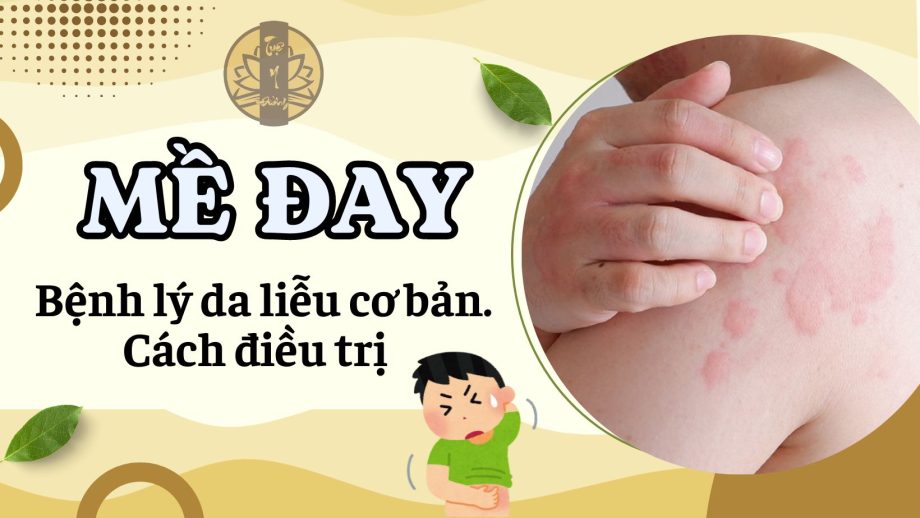 Mề đay - Bệnh lý da liễu cơ bản và cách điều trị