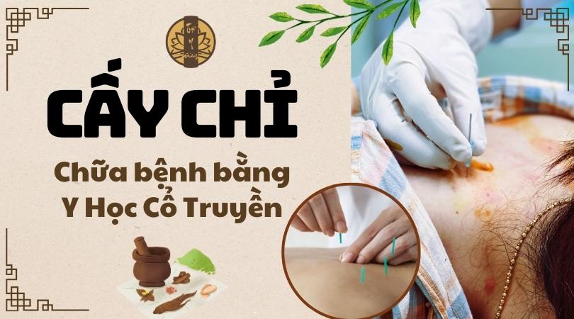 Cấy chỉ - Chữa bệnh bằng Y Học Cổ Truyền