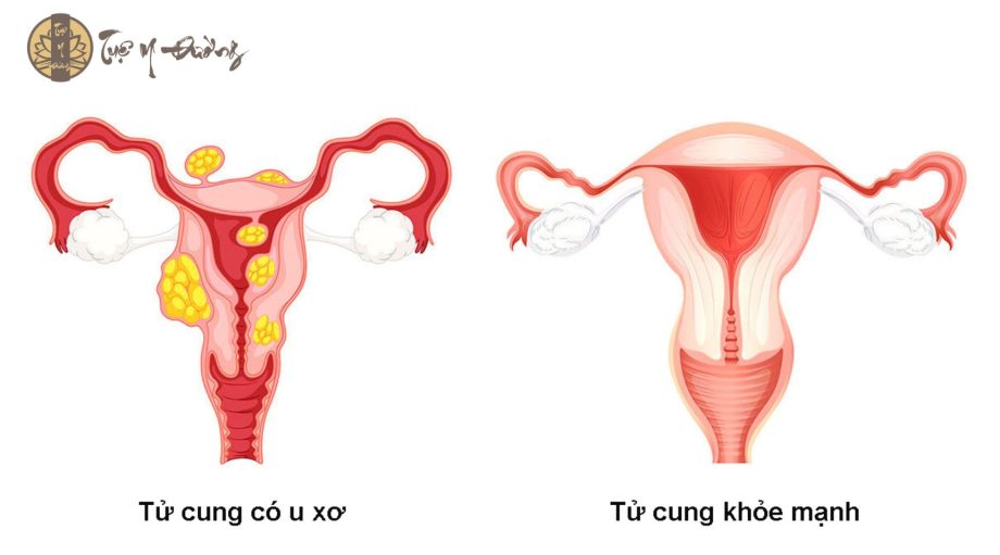 U xơ tử cung và u xơ khỏe mạnh 