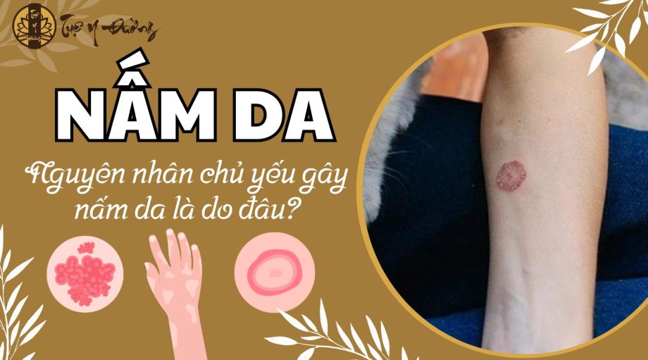 Nấm da - Nguyên nhân chủ yếu gây nấm da là do đâu?