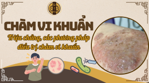 Chàm vi khuẩn - Triệu chứng nguyên nhân và cách điều trị