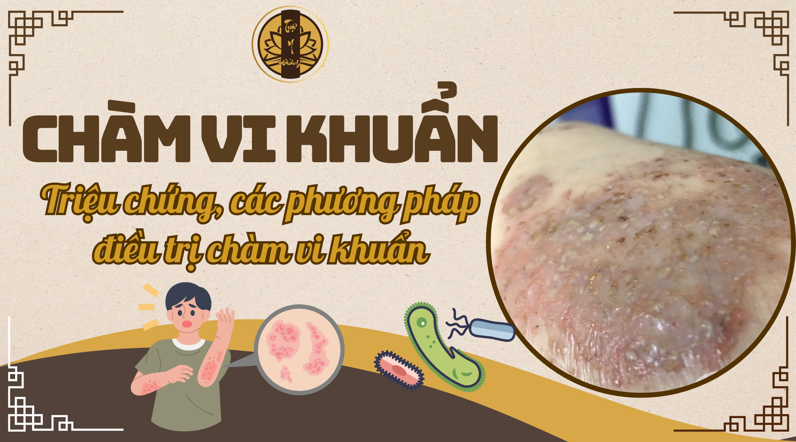 Chàm vi khuẩn - Triệu chứng nguyên nhân và cách điều trị