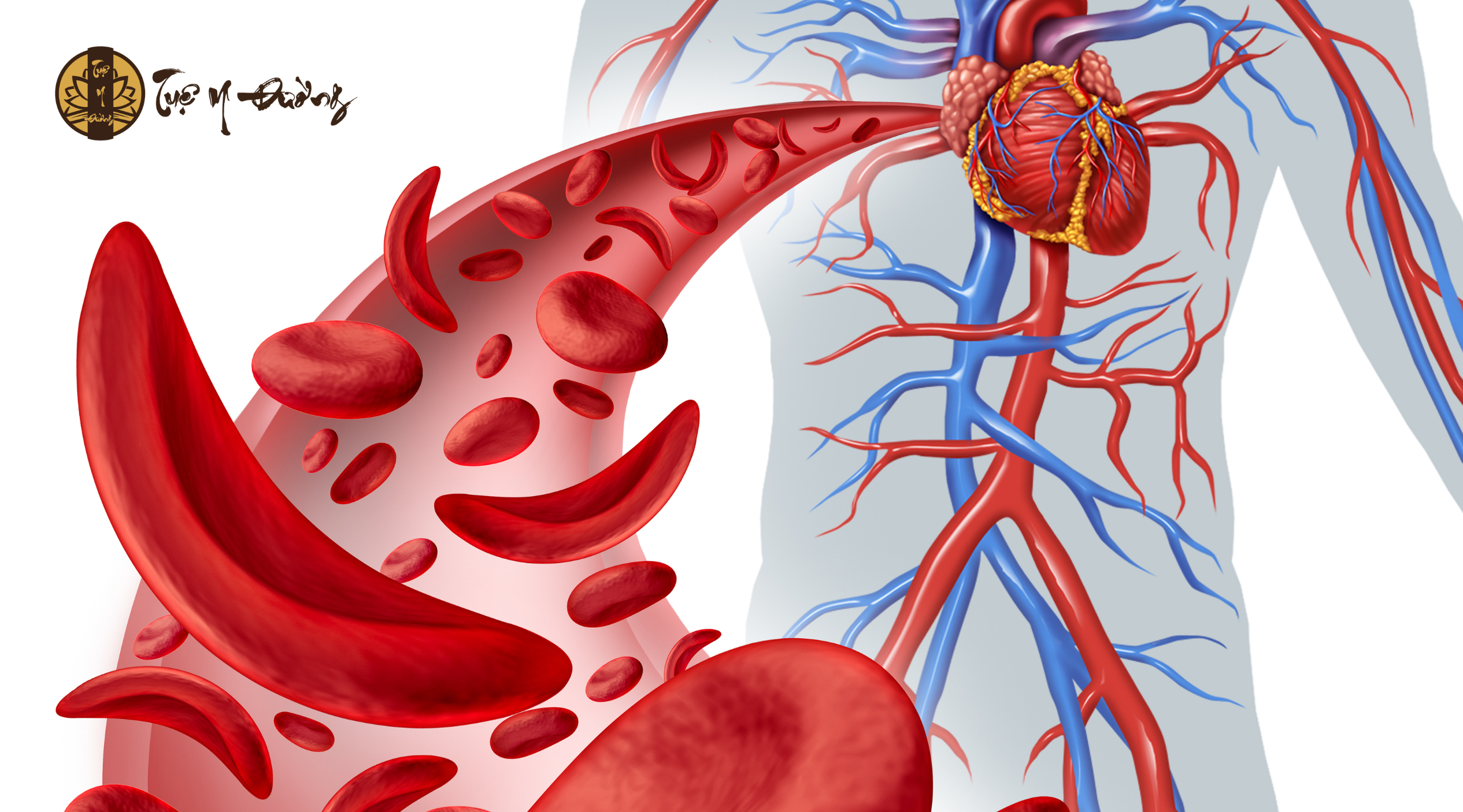 Thiếu máu là tình trạng giảm số lượng hồng cầu (RBC), dẫn đến giảm hematocrit và hàm lượng huyết sắc tố trong hồng cầu