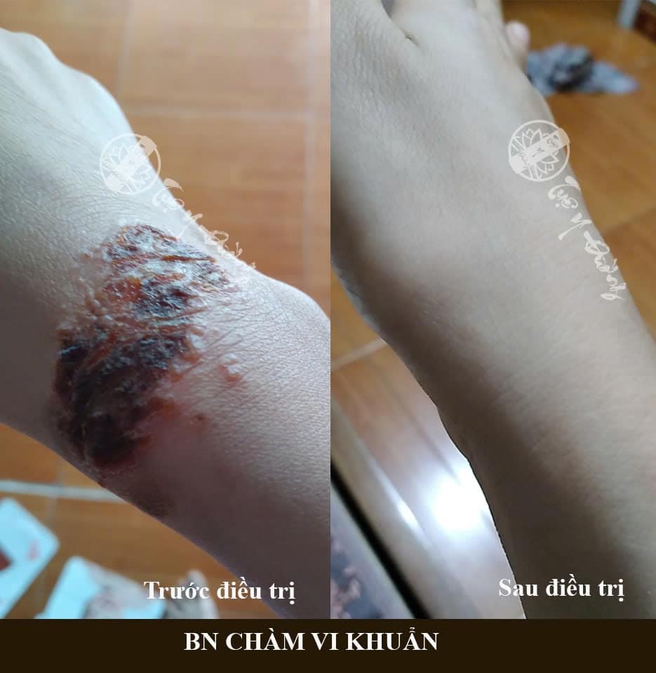 Phản hồi của bệnh nhân sau điều trị chàm vi khuẩn tại Tuệ Y đường