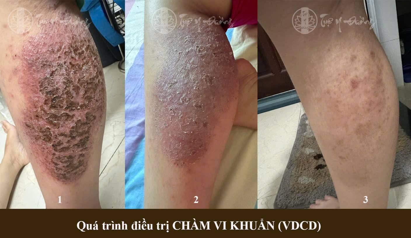 Phản hồi sau điều trị chàm vi khuẩn tại Tuệ Y Đường