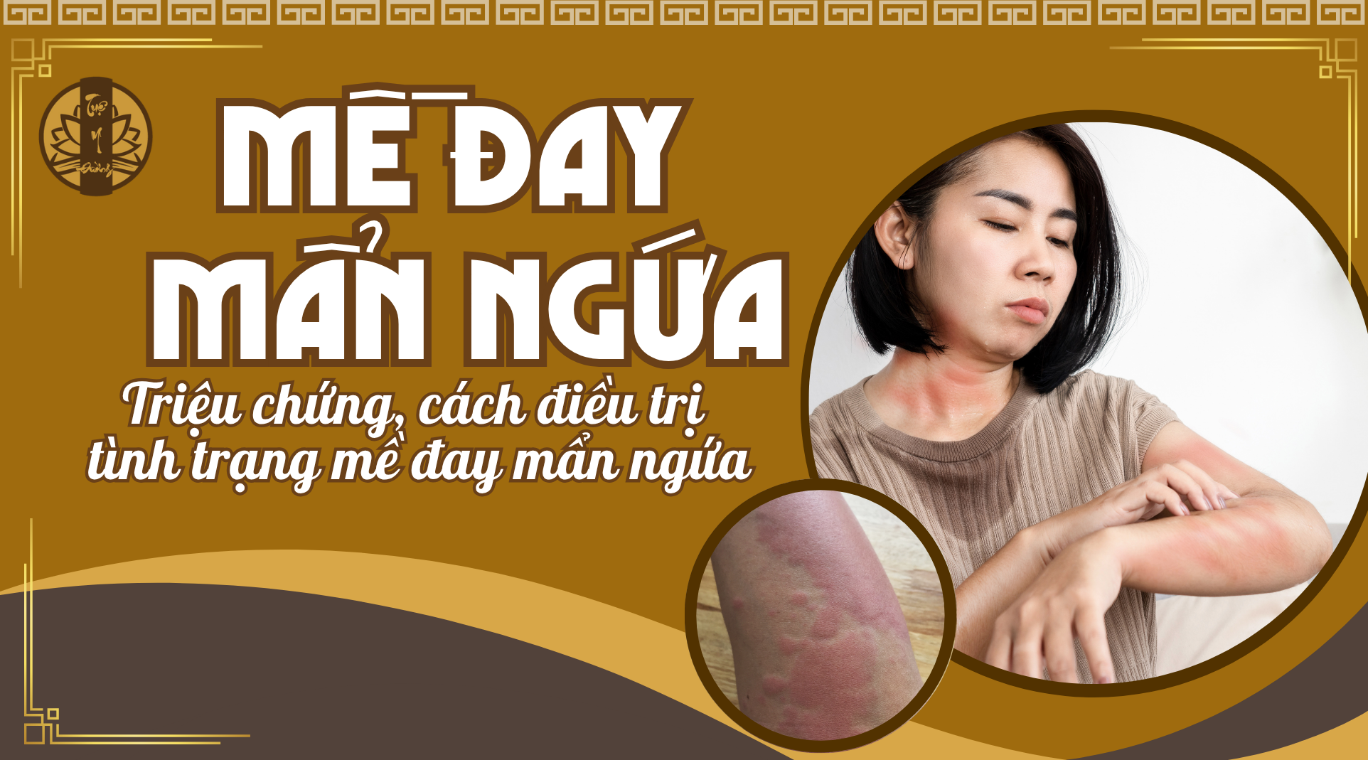 Mề đay mẩn ngứa - triệu chứng, cách điều trị tình trạng mề đay mẩn ngứa