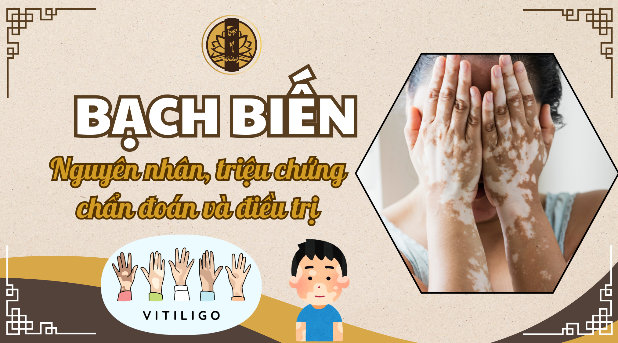 Bệnh Bạch Biến - Nguyên nhân, triệu chứng, chẩn đoán và cách điều trị