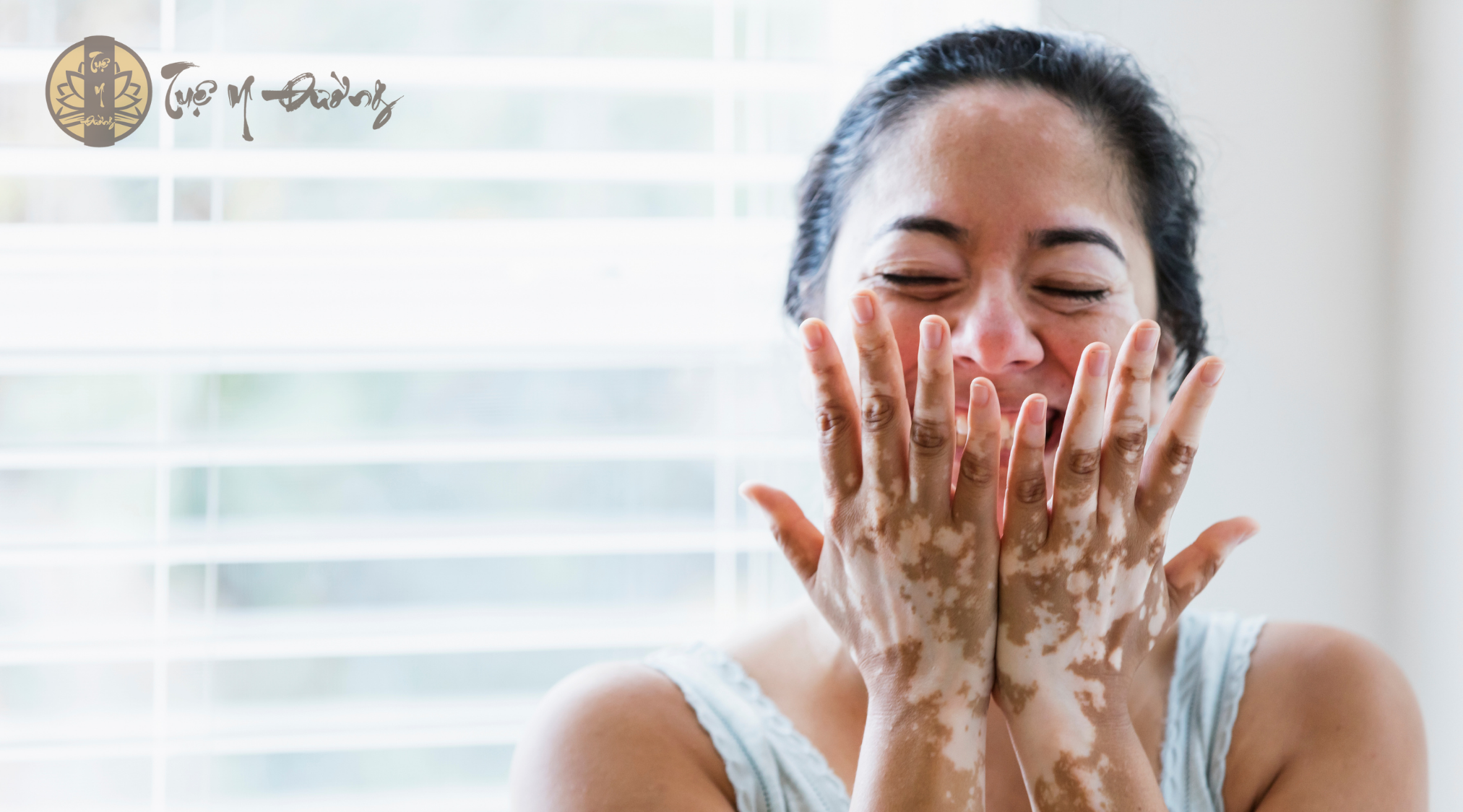 Triệu chứng chính của bệnh bạch biến là những dát, mảng trắng, giới hạn rõ, mất sắc tố da so với vùng da xung quanh do các tế bào sắc tố da ở đó đã không còn hoặc đã ngưng hoạt động.
