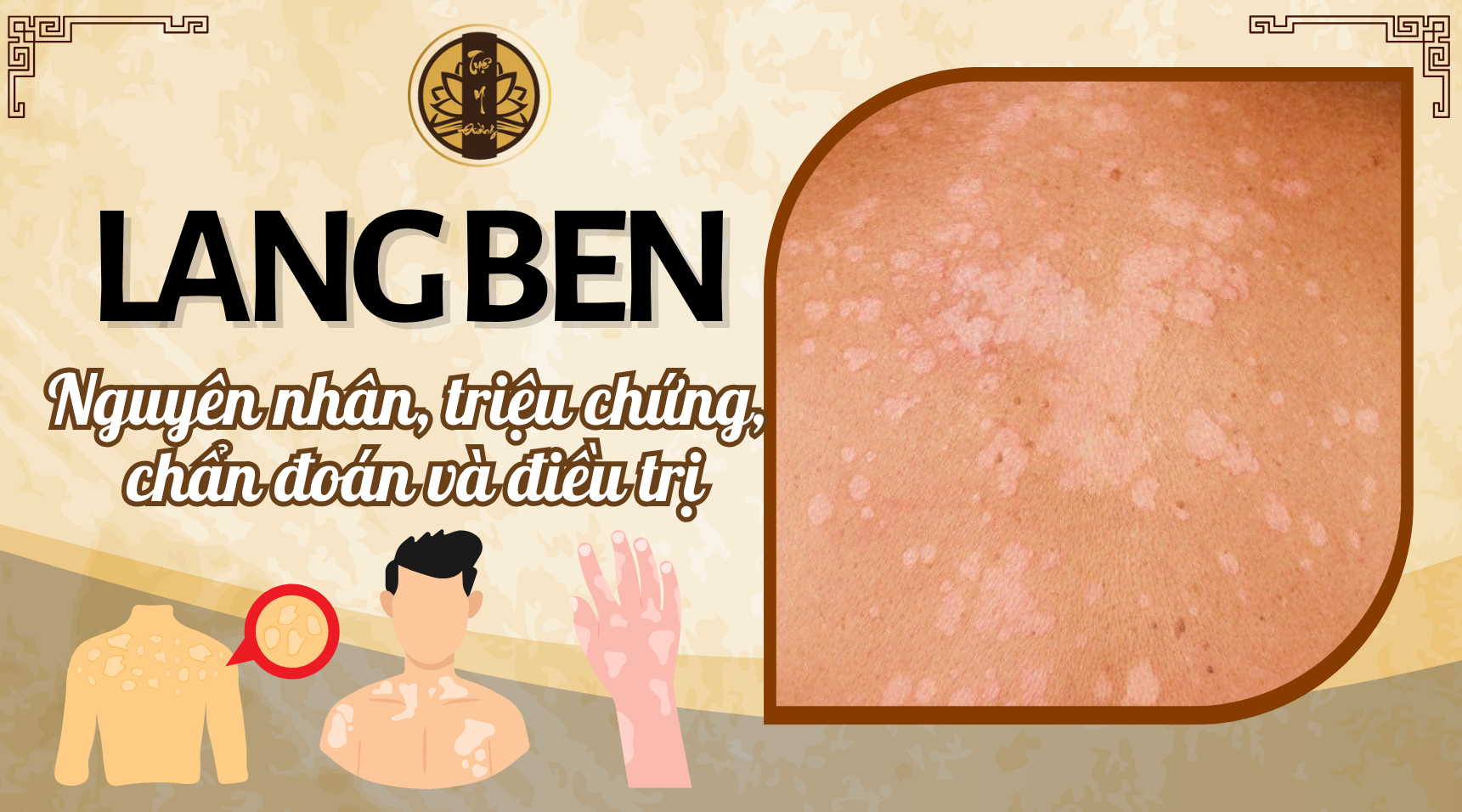 Lang ben - nguyên nhâm, chẩn đoán và điều trị