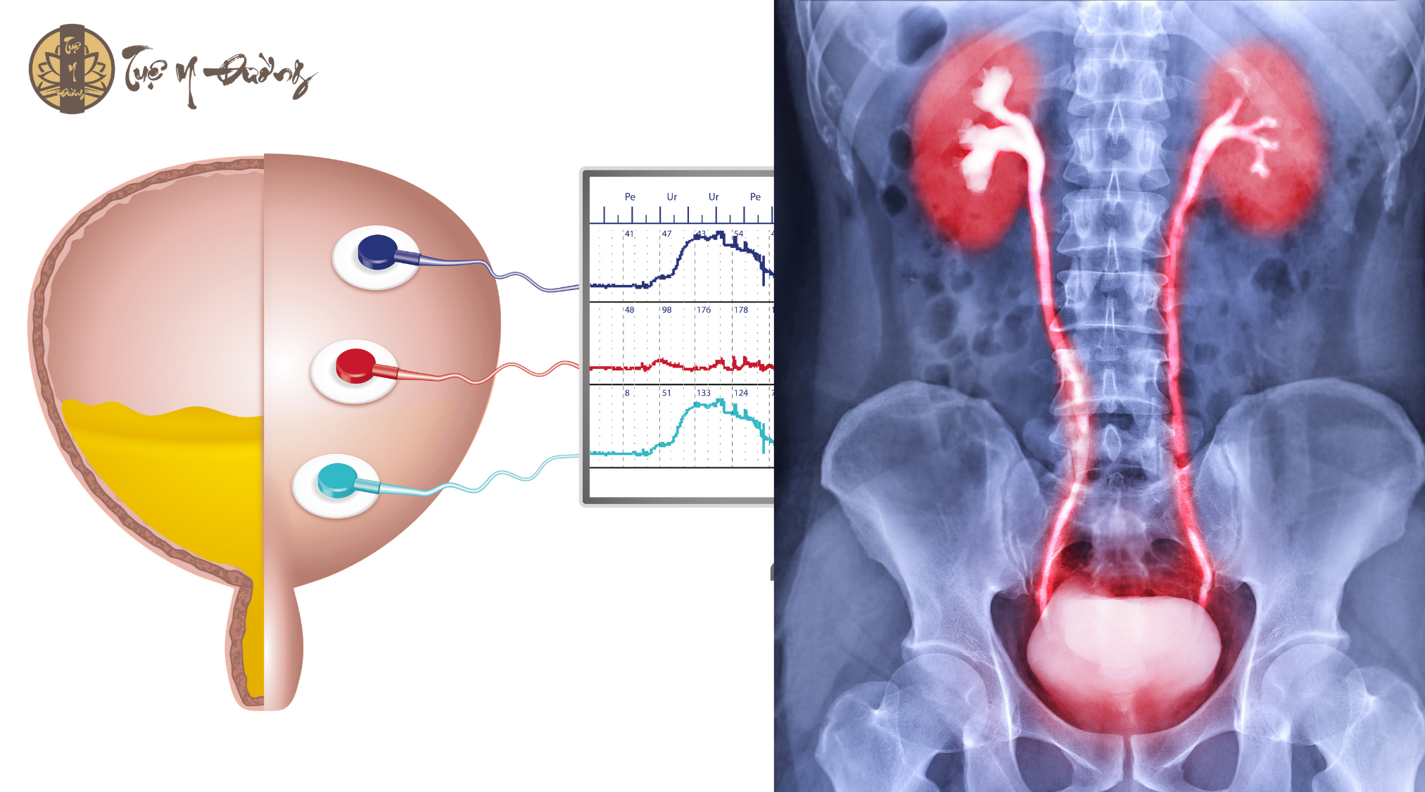 bàng quang tăng hoạt để chỉ sự rối loạn trong giai đoạn đổ đầy nước tiểu của bàng quang. Tình trạng bàng quang tăng hoạt là do sự co bóp không tự chủ của cơ bàng quang trong khi bệnh nhân vẫn đang kiềm chế phản xạ đi tiểu.