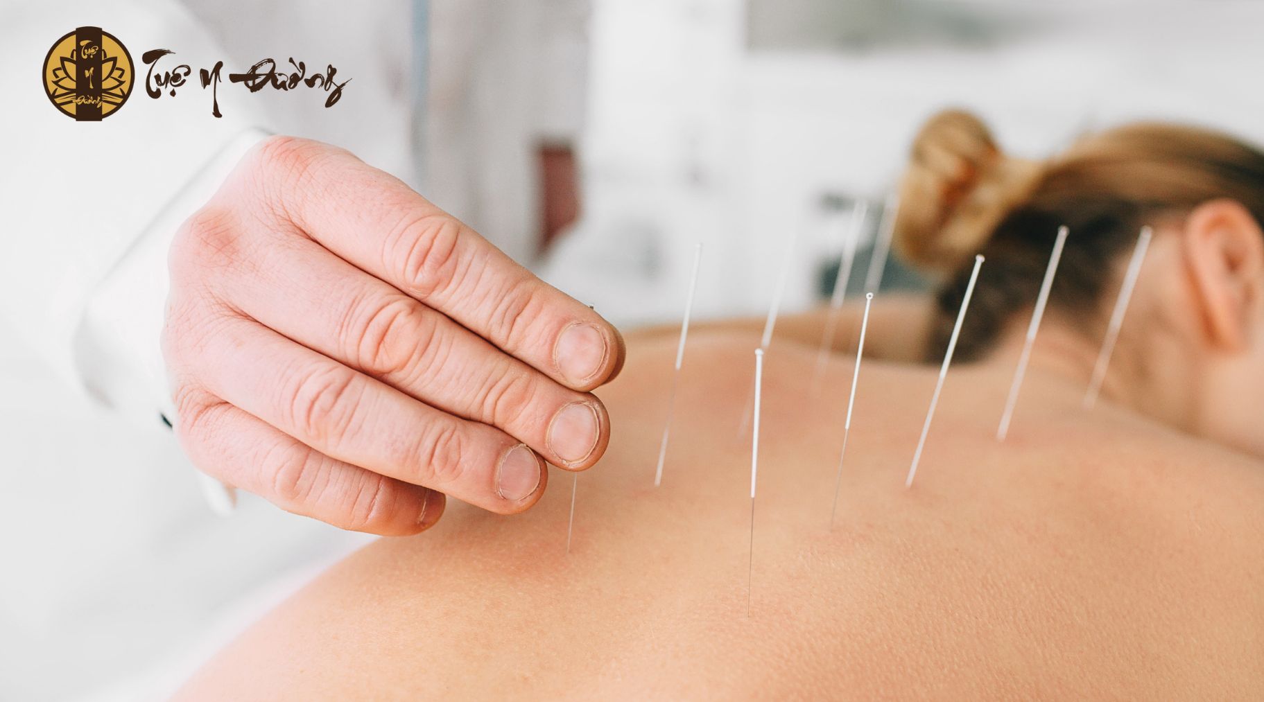 Điều trị rối loạn ngôn ngữ bằng châm cứu