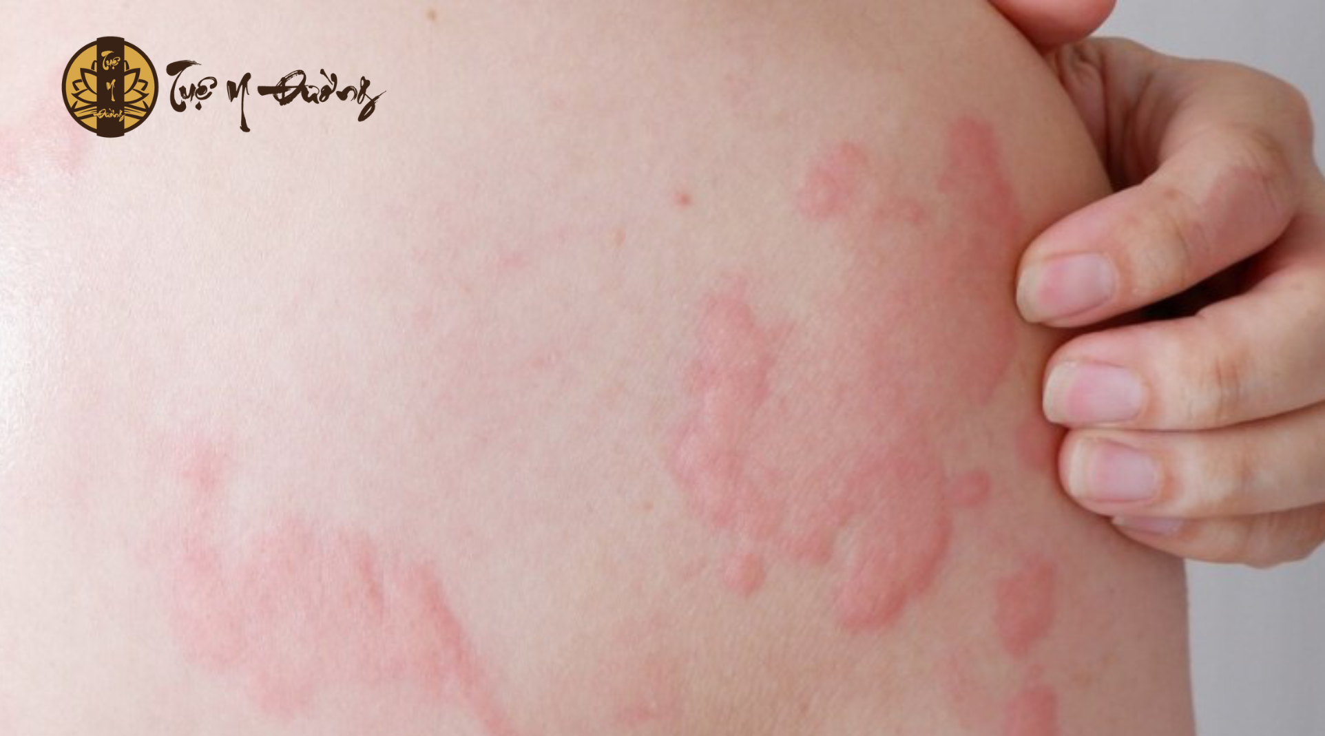 Tình trạng mề đay cấp tính