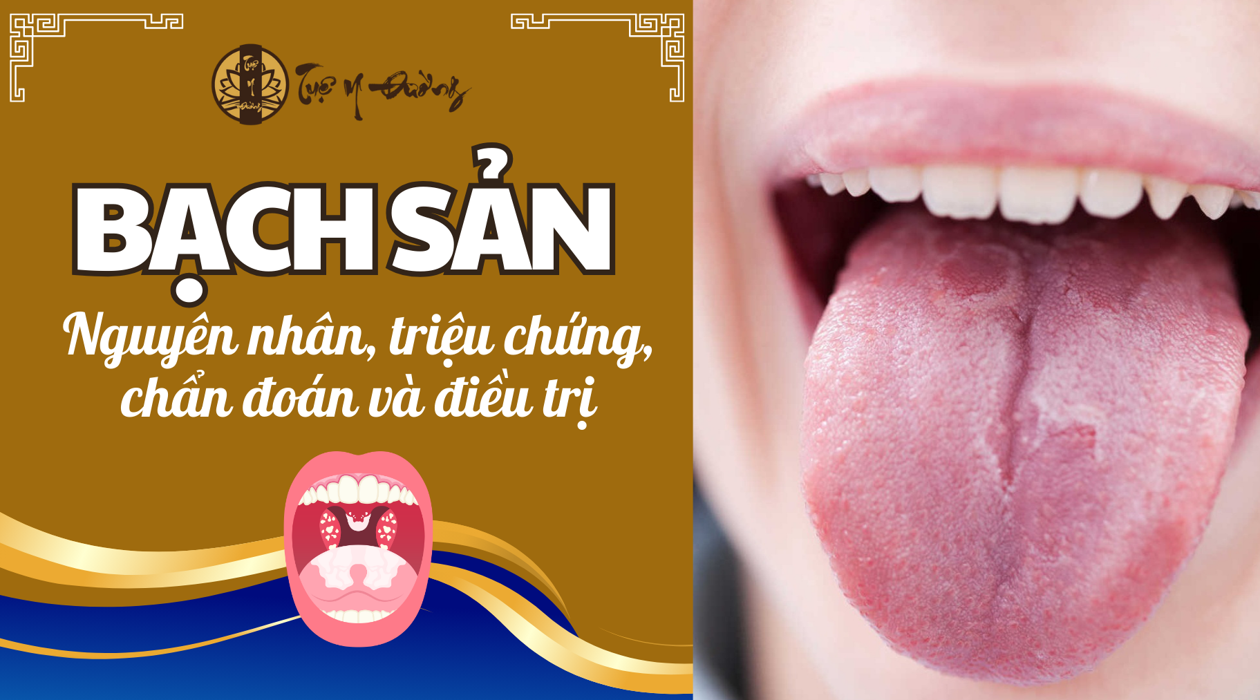 Bạch sản - Nguyên nhân, triệu chứng, chẩn đoán và điều trị