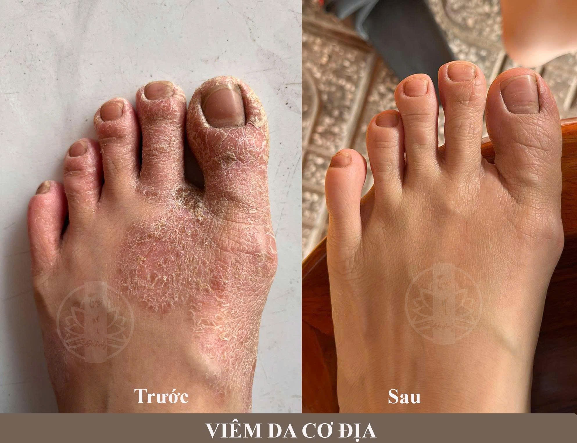 Phản hồi tích cực của bệnh nhân sau điều trị viêm da cơ địa tại Tuệ Y Đường