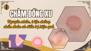 Chàm đồng xu - Nguyên nhân, triệu chứng, cách điều trị hiệu quả