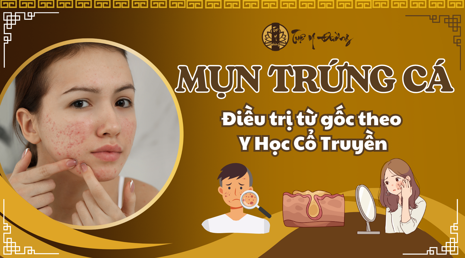 Mụn trứng cá - Điều trị từ góc nhìn Y Học Cổ Truyền