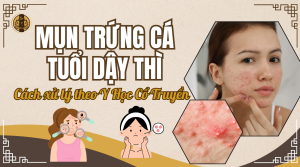 Mụn trứng cá tuổi dậy thì và tuổi trưởng thành theo Y Học Cổ Truyền
