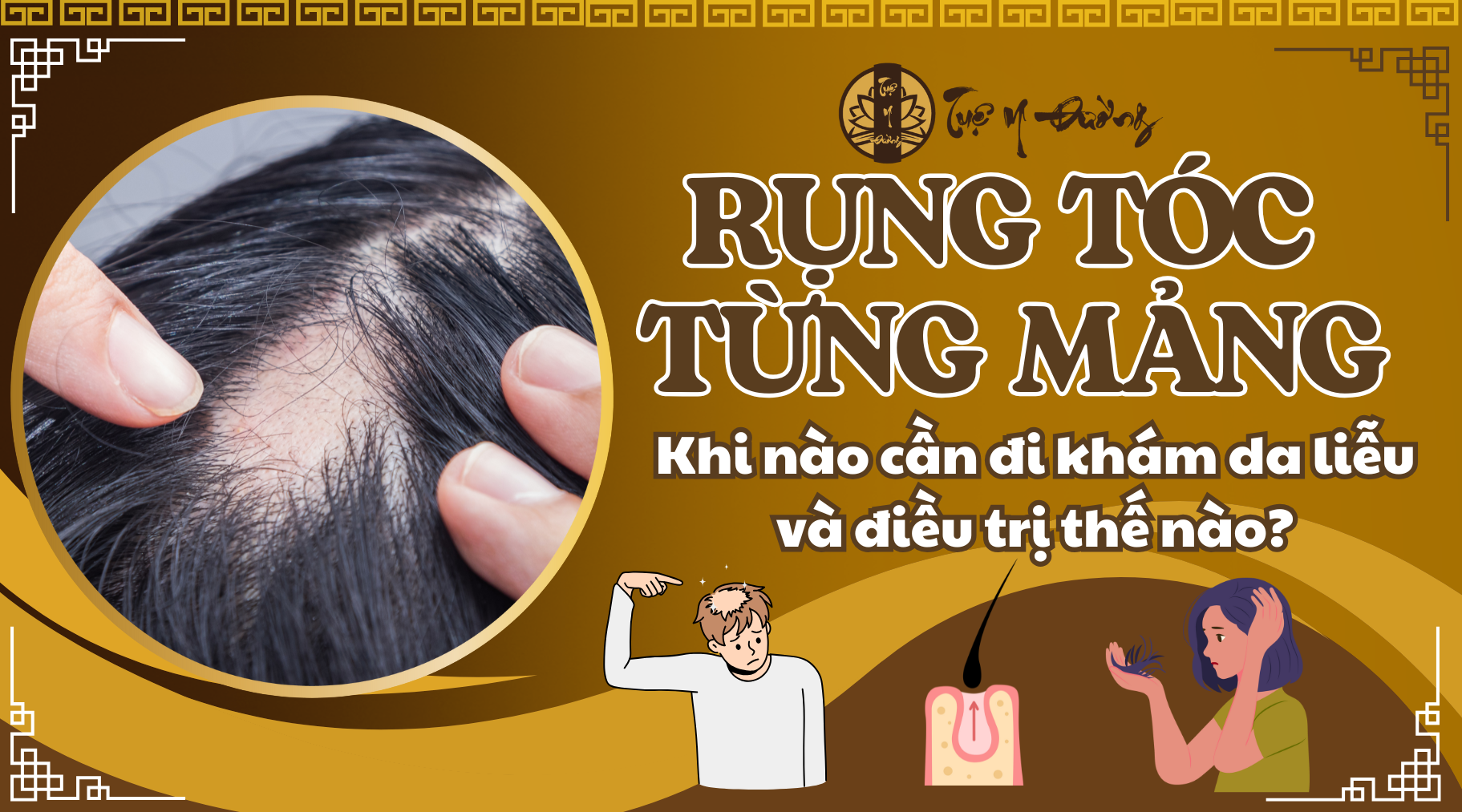 Rụng tóc từng mảng, rụng tóc nội tiết khi nào cần đi điều trị