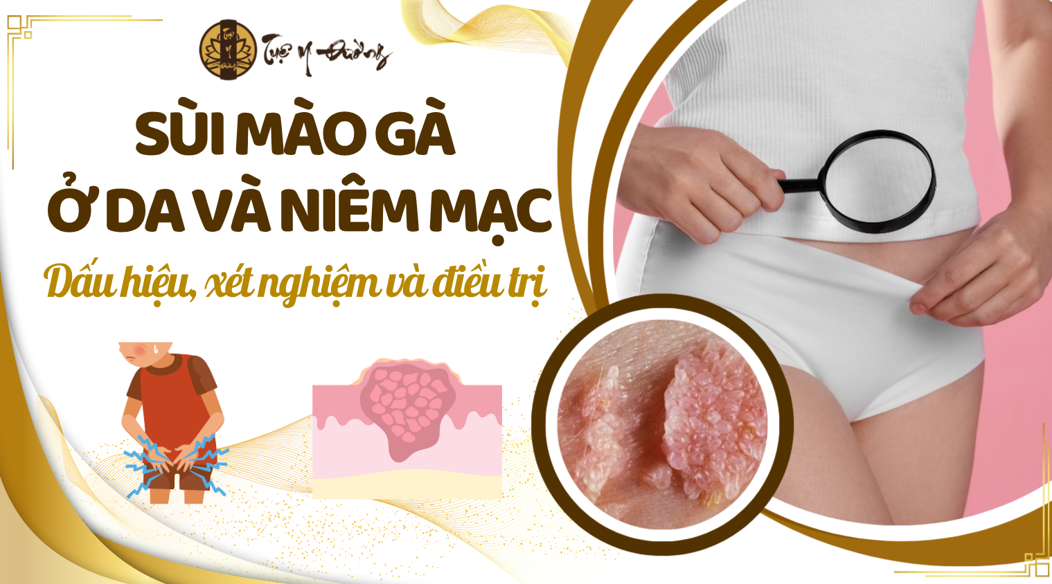 Sùi mào gà ở da và niêm mạc - Dấu hiệu và điều trị