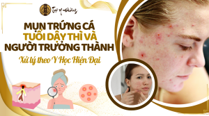 Mụn trứng cá tuổi dậy thì và người trưởng thành - Cách điều trị theo y học hiện đại