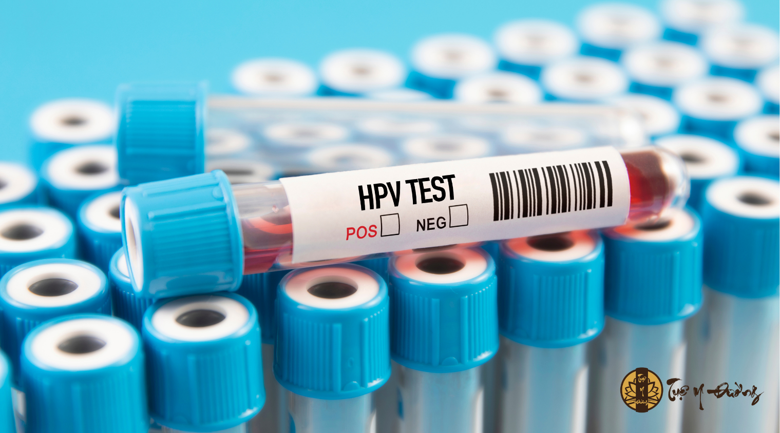 Chẩn đoán sùi mào gà thông qua xét nghiệm HPV