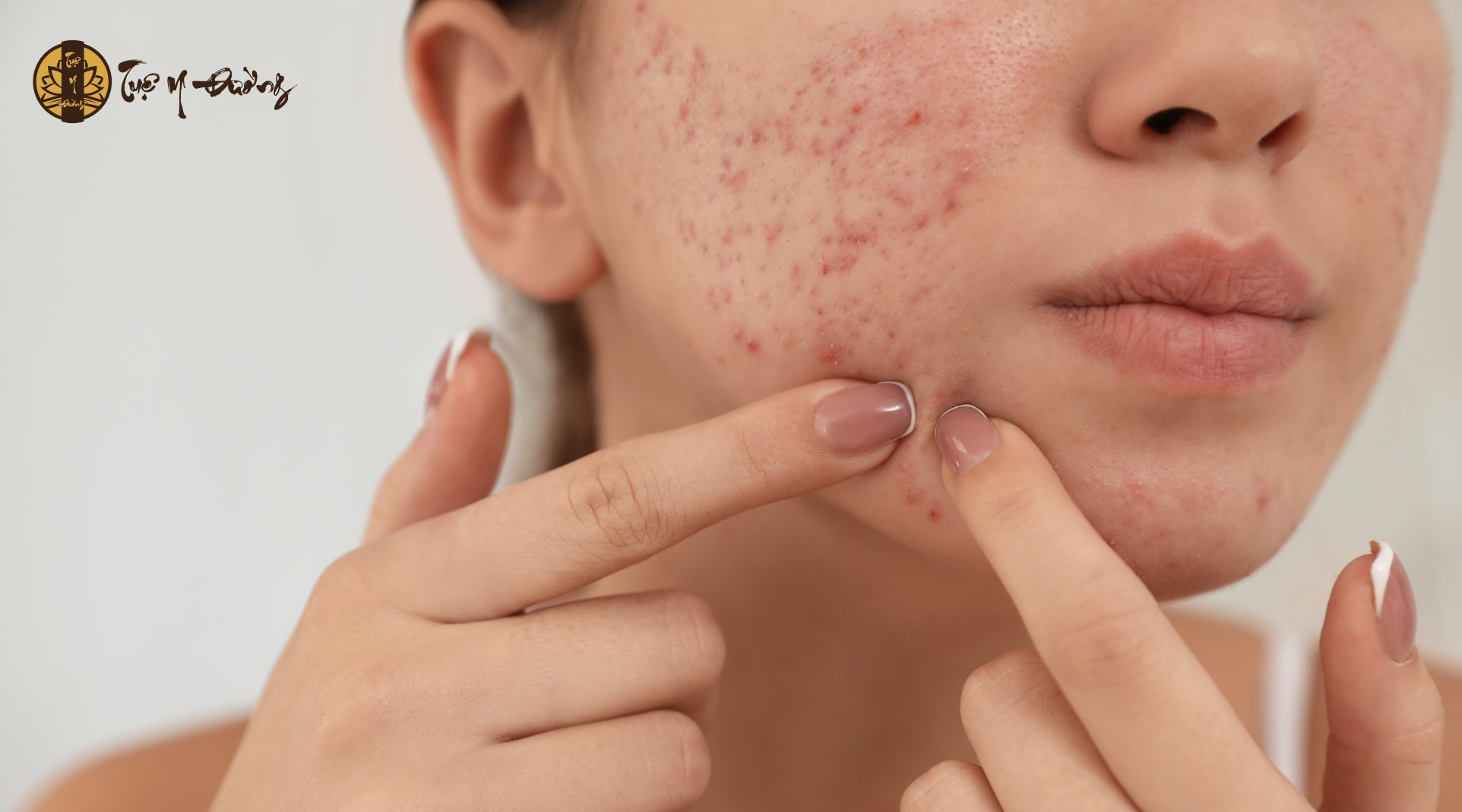 Vị thuốc Tỏi có khả năng sát khuẩn và tiêu viêm mạnh, giúp làm sạch ổ viêm và hạn chế mụn nhọt phát triển.