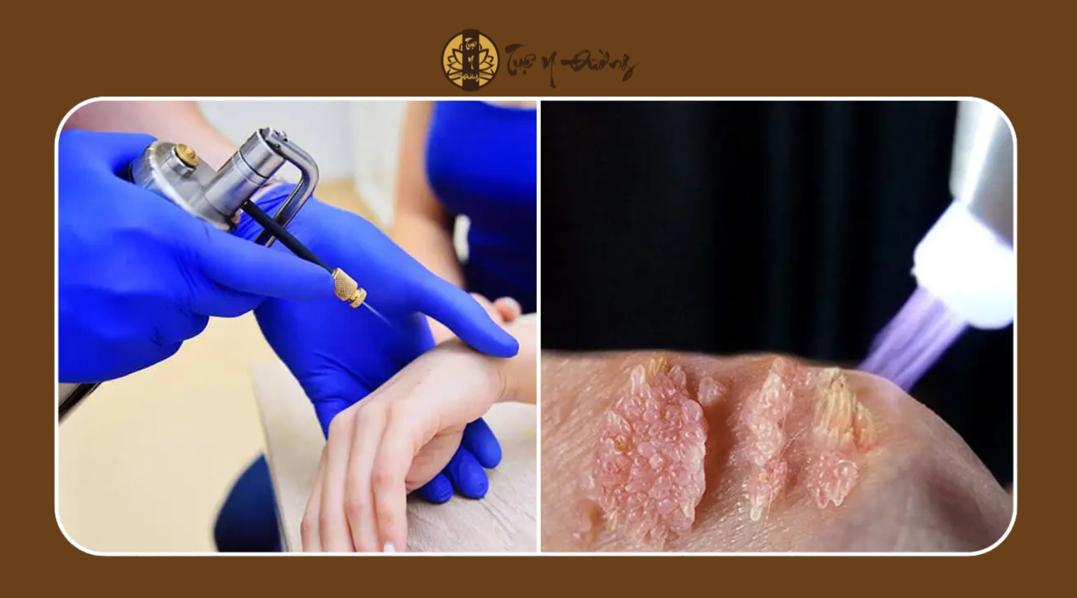 Sử dụng phương pháp đốt điện trong điều trị sùi mào gà