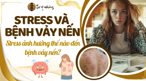 Stress ảnh hưởng như thế nào đến bệnh vảy nến dưới góc nhìn của y học cổ truyền