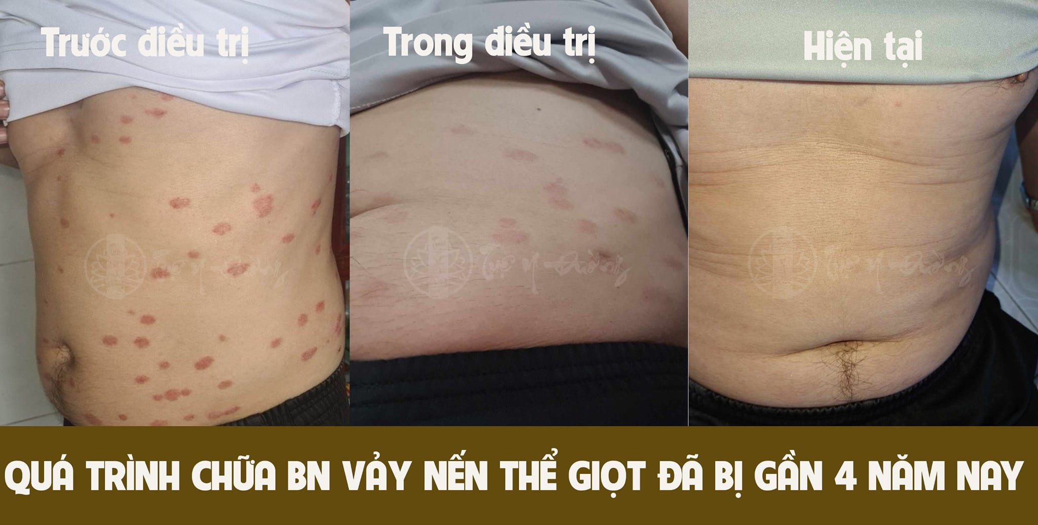 Phản hồi của bệnh nhân sau quá trình điều trị vảy nến tại Tuệ Y Đường